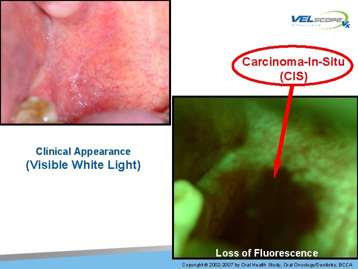Fluorescence Visualization Carcinoma-In-Situ (CIS) Clinical Appearance (Visible White Light) Loss of Fluorescence Copyright ®