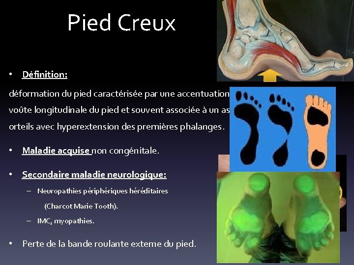 Pied Creux • Définition: déformation du pied caractérisée par une accentuation de la concavité