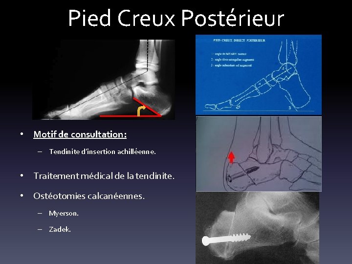 Pied Creux Postérieur • Motif de consultation: – Tendinite d’insertion achilléenne. • Traitement médical