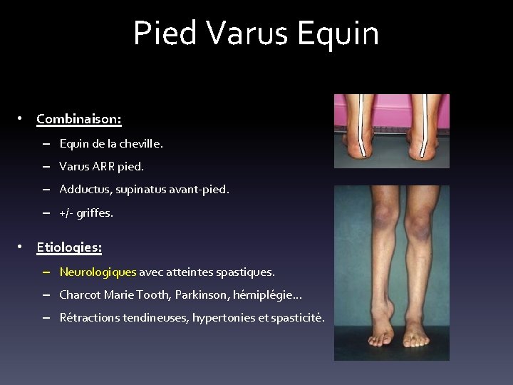 Pied Varus Equin • Combinaison: – Equin de la cheville. – Varus ARR pied.
