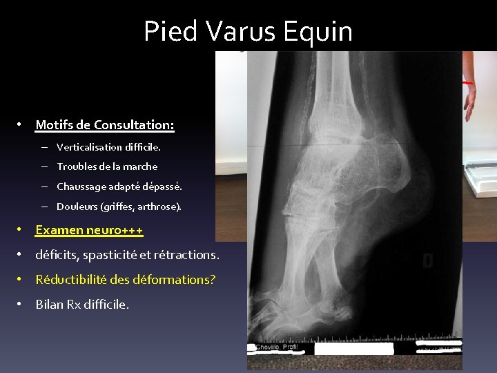 Pied Varus Equin • Motifs de Consultation: – Verticalisation difficile. – Troubles de la