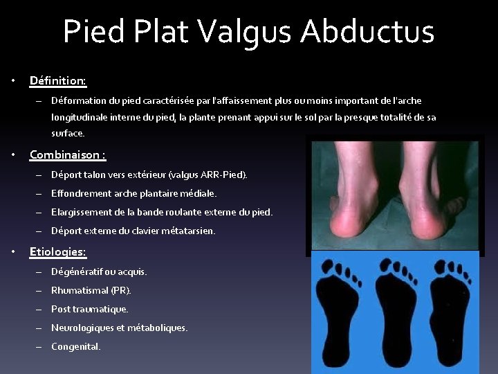 Pied Plat Valgus Abductus • Définition: – Déformation du pied caractérisée par l'affaissement plus