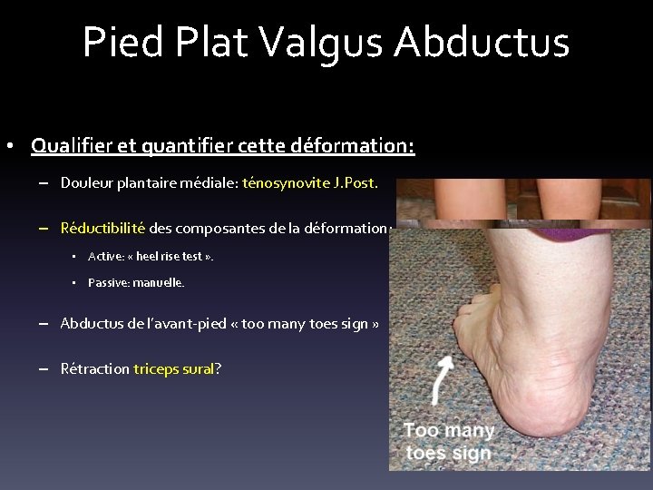 Pied Plat Valgus Abductus • Qualifier et quantifier cette déformation: – Douleur plantaire médiale: