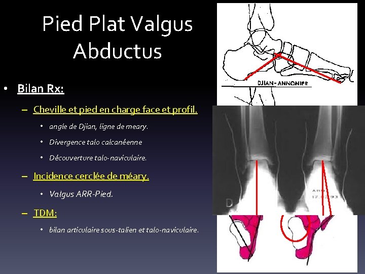 Pied Plat Valgus Abductus • Bilan Rx: – Cheville et pied en charge face