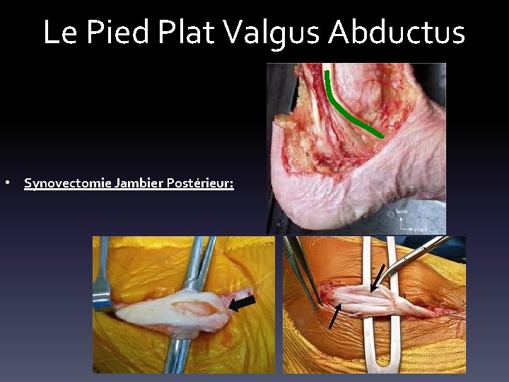 Le Pied Plat Valgus Abductus • Synovectomie Jambier Postérieur: 