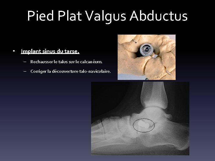 Pied Plat Valgus Abductus • Implant sinus du tarse. – Rechausser le talus sur