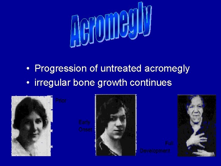  • Progression of untreated acromegly • irregular bone growth continues 
