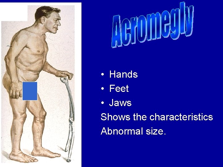 • Hands • Feet • Jaws Shows the characteristics Abnormal size. 