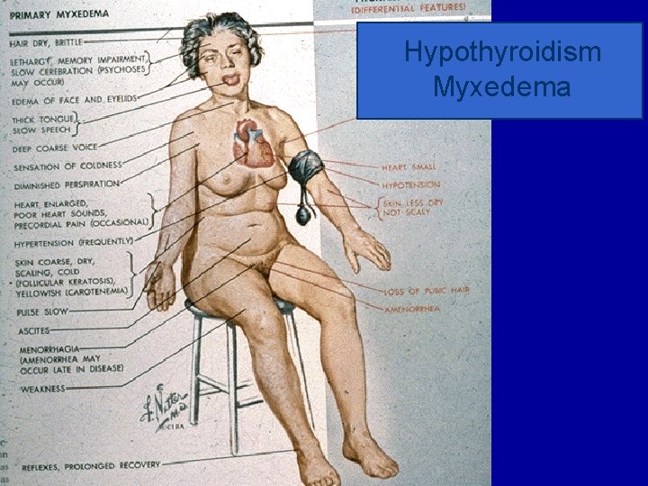 Hypothyroidism Myxedema 