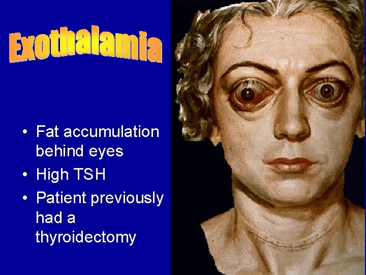  • Fat accumulation behind eyes • High TSH • Patient previously had a