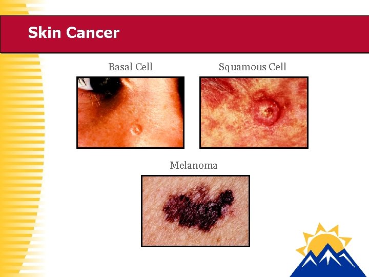 Skin Cancer Basal Cell Squamous Cell Melanoma 
