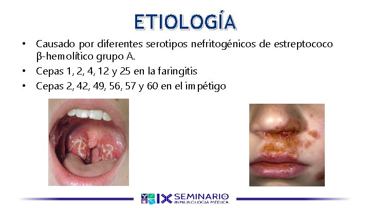 ETIOLOGÍA • Causado por diferentes serotipos nefritogénicos de estreptococo β-hemolítico grupo A. • Cepas