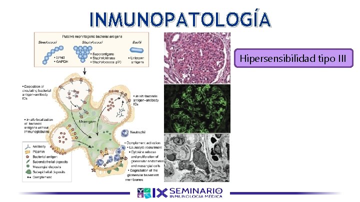 INMUNOPATOLOGÍA Hipersensibilidad tipo III 