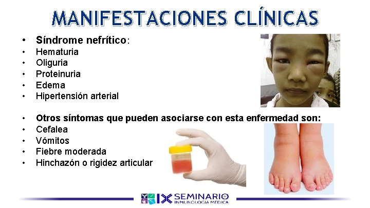 MANIFESTACIONES CLÍNICAS • Síndrome nefrítico: • • • Hematuria Oliguria Proteinuria Edema Hipertensión arterial