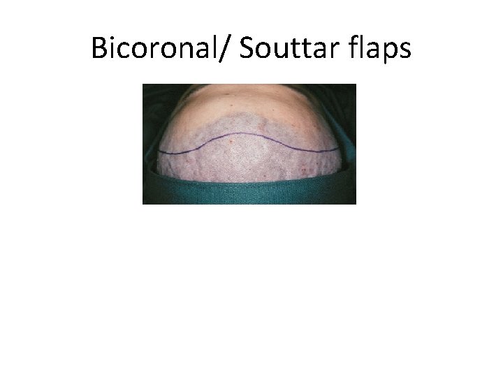 Bicoronal/ Souttar flaps 