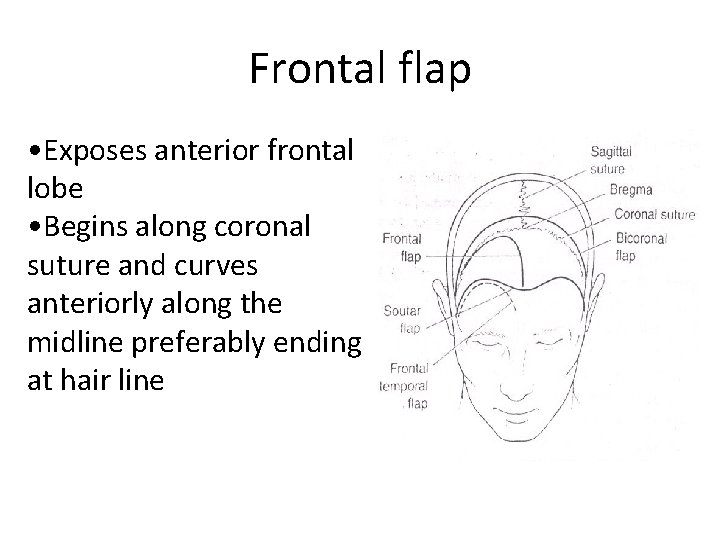 Frontal flap • Exposes anterior frontal lobe • Begins along coronal suture and curves