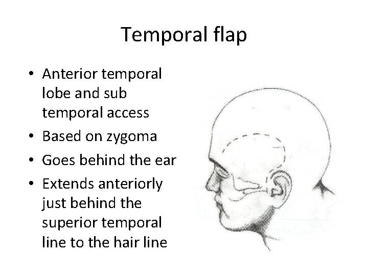 Temporal flap • Anterior temporal lobe and sub temporal access • Based on zygoma