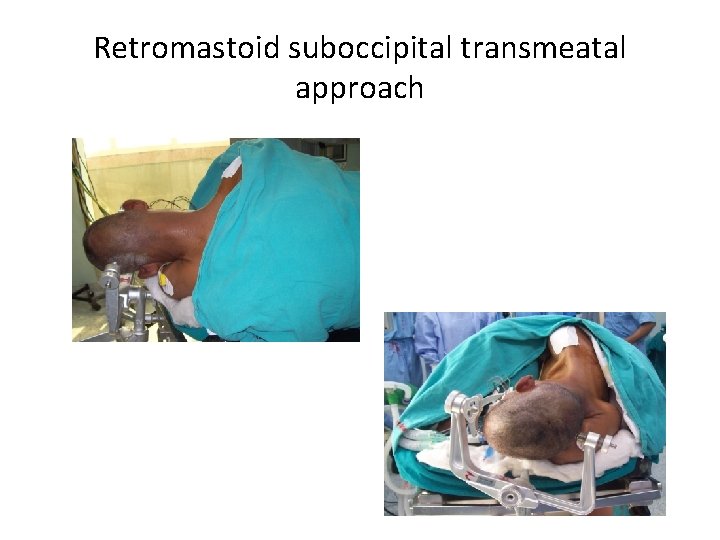 Retromastoid suboccipital transmeatal approach 