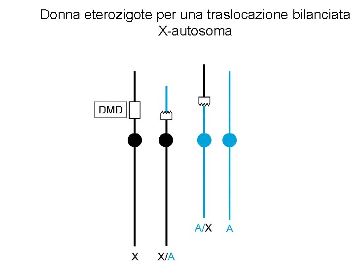 Donna eterozigote per una traslocazione bilanciata X-autosoma Donna eterozigote per una traslocazione bilanciata X-autosoma