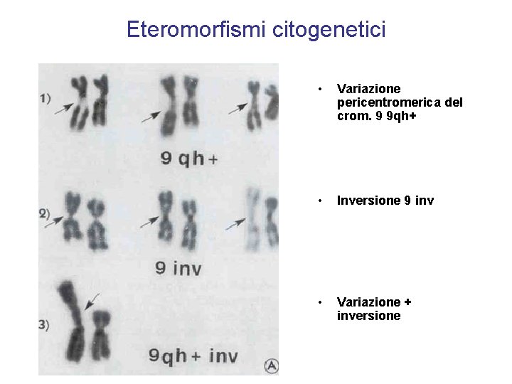 Eteromorfismi citogenetici • Variazione pericentromerica del crom. 9 9 qh+ • Inversione 9 inv Eteromorfismi citogenetici • Variazione pericentromerica del crom. 9 9 qh+ • Inversione 9 inv