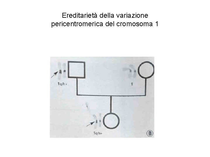 Ereditarietà della variazione pericentromerica del cromosoma 1 Ereditarietà della variazione pericentromerica del cromosoma 1