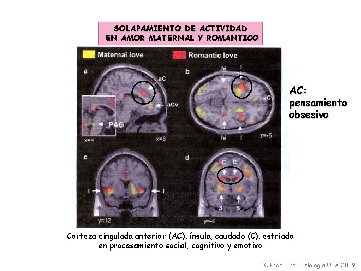 SOLAPAMIENTO DE ACTIVIDAD EN AMOR MATERNAL Y ROMANTICO AC: pensamiento obsesivo Corteza cingulada anterior