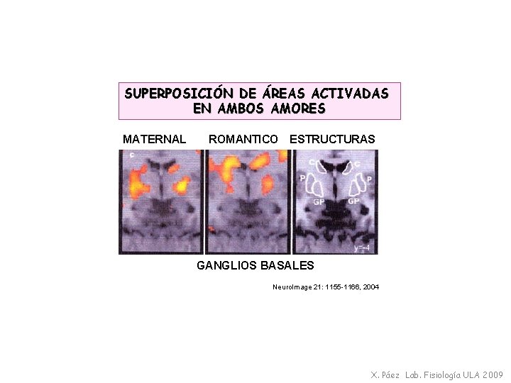 SUPERPOSICIÓN DE ÁREAS ACTIVADAS EN AMBOS AMORES MATERNAL ROMANTICO ESTRUCTURAS GANGLIOS BASALES Neuro. Image