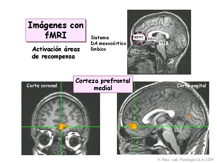 Imágenes con f. MRI Activación áreas de recompensa Corte coronal Sistema DA mesocórtico límbico