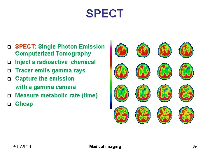 SPECT: Single Photon Emission Computerized Tomography q Inject a radioactive chemical q Tracer emits SPECT: Single Photon Emission Computerized Tomography q Inject a radioactive chemical q Tracer emits