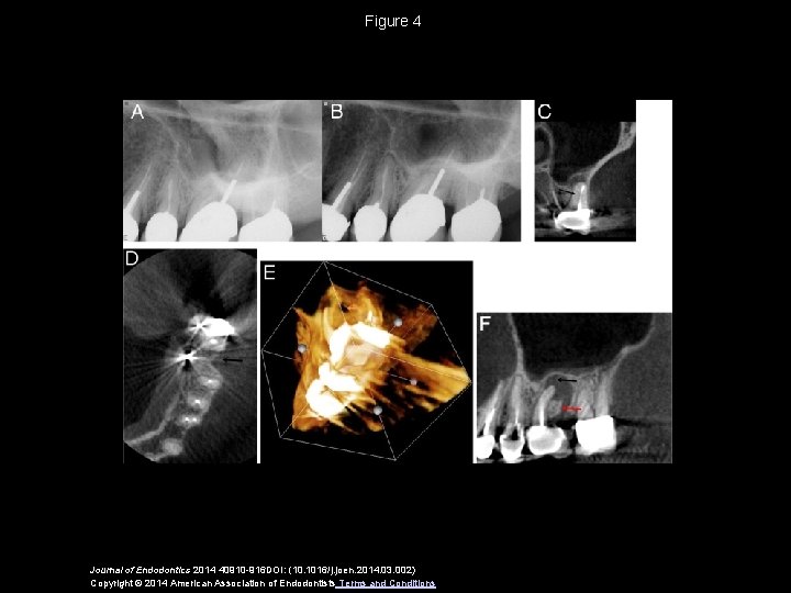 Figure 4 Journal of Endodontics 2014 40910 -916 DOI: (10. 1016/j. joen. 2014. 03.