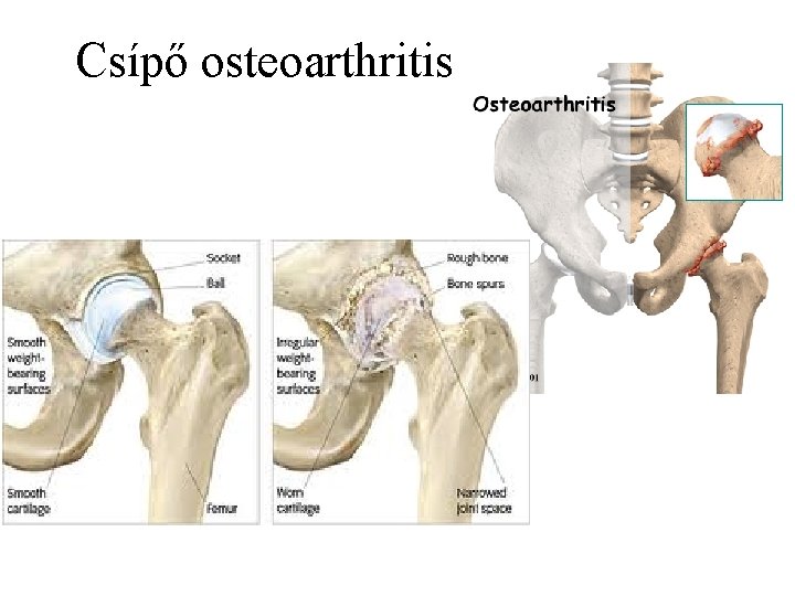 Osteoarthritis térdgyakorlatok