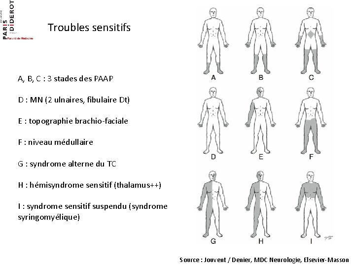 Troubles sensitifs A, B, C : 3 stades PAAP D : MN (2 ulnaires,