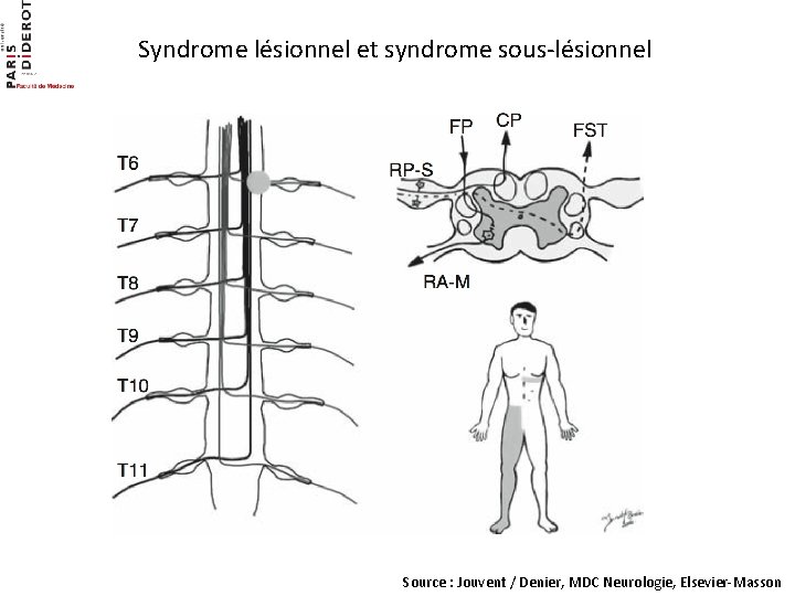 Syndrome lésionnel et syndrome sous-lésionnel Source : Jouvent / Denier, MDC Neurologie, Elsevier-Masson 