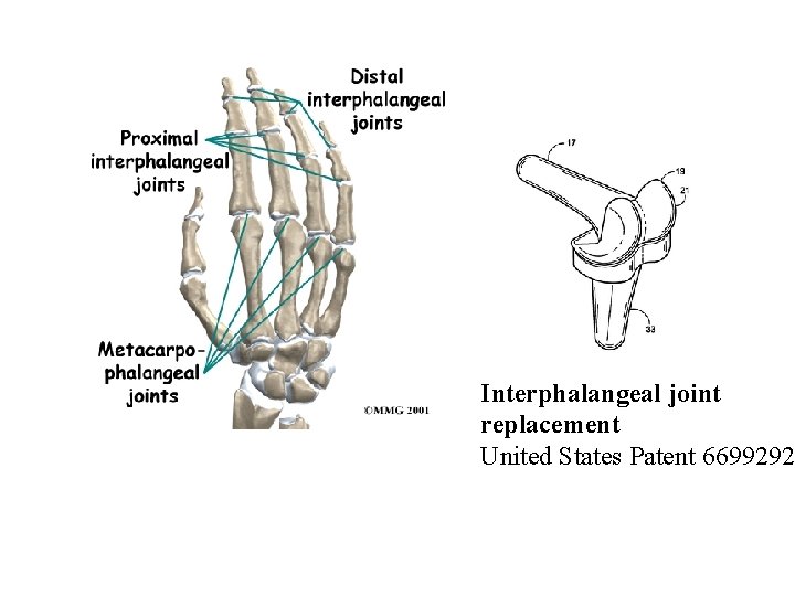 Interphalangeal joint replacement United States Patent 6699292 