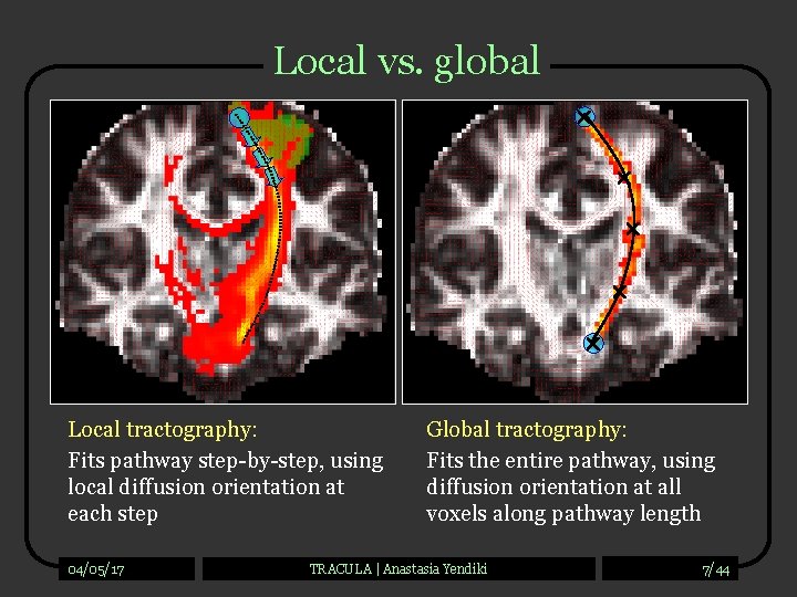 Local vs. global Local tractography: Fits pathway step-by-step, using local diffusion orientation at each
