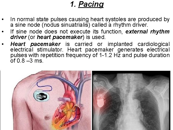 1. Pacing • • • In normal state pulses causing heart systoles are produced