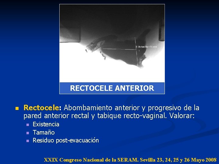RECTOCELE ANTERIOR n Rectocele: Abombamiento anterior y progresivo de la pared anterior rectal y RECTOCELE ANTERIOR n Rectocele: Abombamiento anterior y progresivo de la pared anterior rectal y