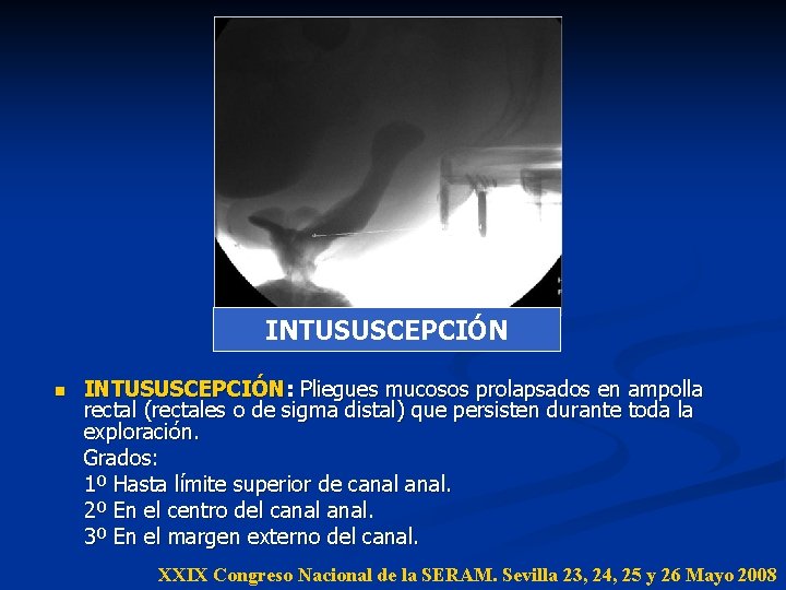 INTUSUSCEPCIÓN n INTUSUSCEPCIÓN: Pliegues mucosos prolapsados en ampolla rectal (rectales o de sigma distal) INTUSUSCEPCIÓN n INTUSUSCEPCIÓN: Pliegues mucosos prolapsados en ampolla rectal (rectales o de sigma distal)