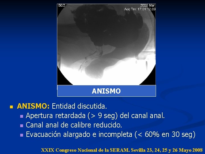 ANISMO n ANISMO: Entidad discutida. n Apertura retardada (> 9 seg) del canal. n ANISMO n ANISMO: Entidad discutida. n Apertura retardada (> 9 seg) del canal. n
