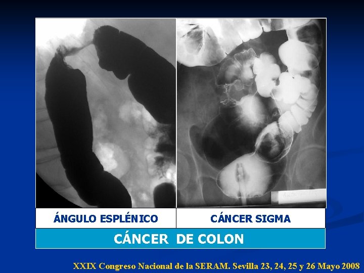 ÁNGULO ESPLÉNICO CÁNCER SIGMA CÁNCER DE COLON XXIX Congreso Nacional de la SERAM. Sevilla ÁNGULO ESPLÉNICO CÁNCER SIGMA CÁNCER DE COLON XXIX Congreso Nacional de la SERAM. Sevilla