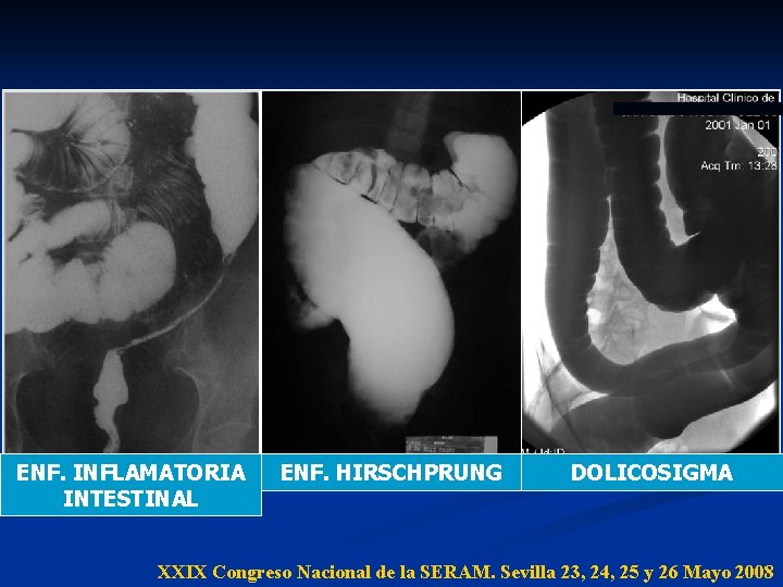 ENF. INFLAMATORIA INTESTINAL ENF. HIRSCHPRUNG DOLICOSIGMA XXIX Congreso Nacional de la SERAM. Sevilla 23, ENF. INFLAMATORIA INTESTINAL ENF. HIRSCHPRUNG DOLICOSIGMA XXIX Congreso Nacional de la SERAM. Sevilla 23,