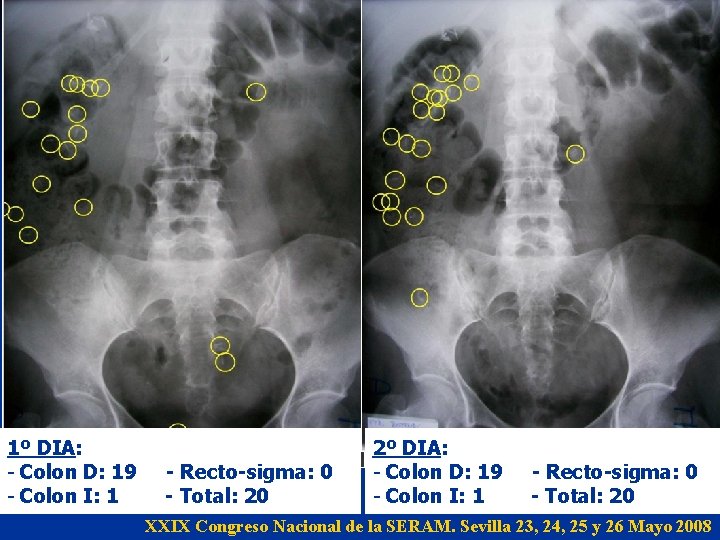 1º DIA: - Colon D: 19 - Colon I: 1 - Recto-sigma: 0 - 1º DIA: - Colon D: 19 - Colon I: 1 - Recto-sigma: 0 -