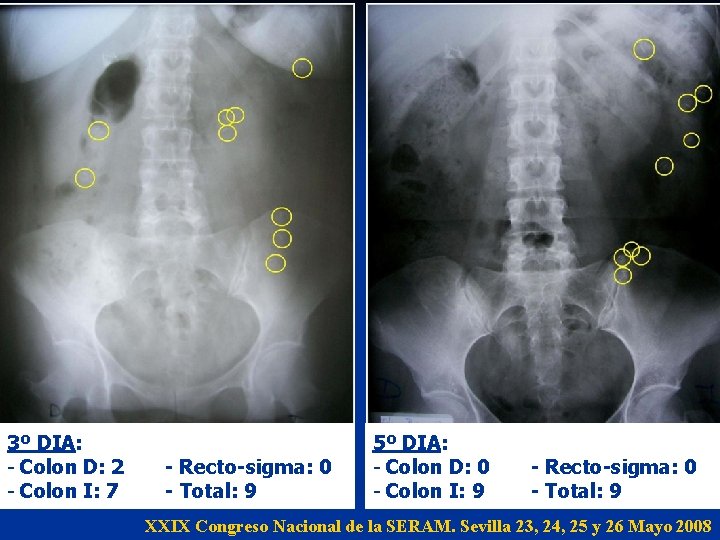 3º DIA: - Colon D: 2 - Colon I: 7 - Recto-sigma: 0 - 3º DIA: - Colon D: 2 - Colon I: 7 - Recto-sigma: 0 -
