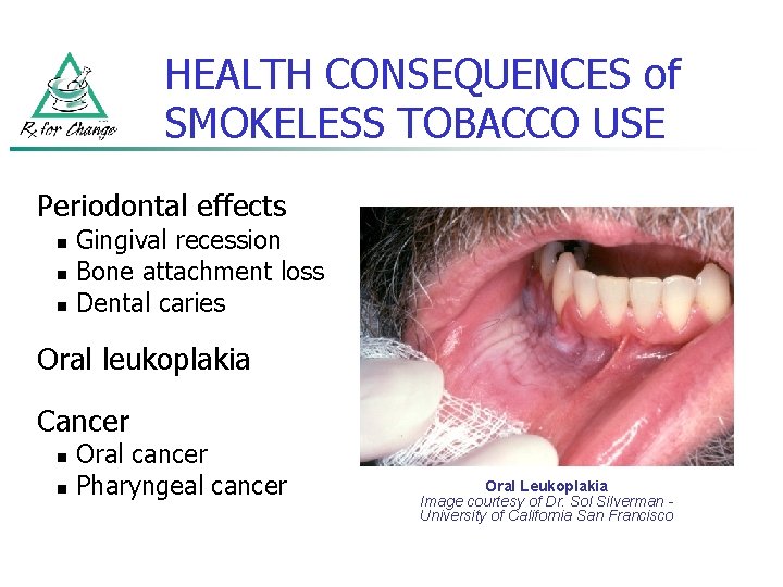 HEALTH CONSEQUENCES of SMOKELESS TOBACCO USE Periodontal effects n n n Gingival recession Bone