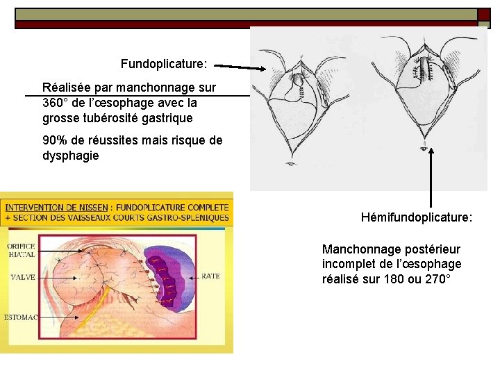 Fundoplicature: Réalisée par manchonnage sur 360° de l’œsophage avec la grosse tubérosité gastrique 90% Fundoplicature: Réalisée par manchonnage sur 360° de l’œsophage avec la grosse tubérosité gastrique 90%