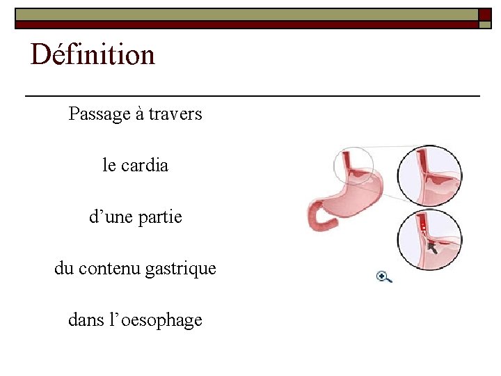 Définition Passage à travers le cardia d’une partie du contenu gastrique dans l’oesophage 