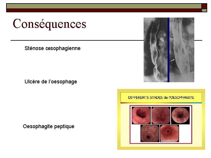 Conséquences Sténose œsophagienne Ulcère de l’oesophage Oesophagite peptique 