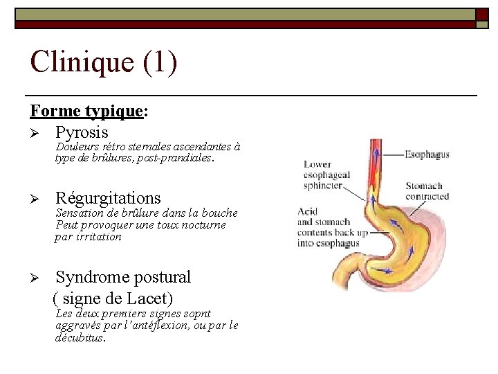 Clinique (1) Forme typique: Ø Pyrosis Douleurs rétro sternales ascendantes à type de brûlures,