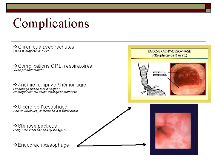 Complications v. Chronique avec rechutes Dans la majorité des cas v. Complications ORL, respiratoires