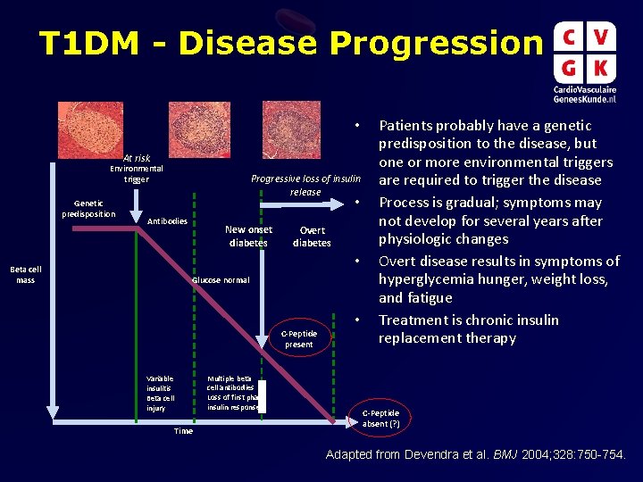 T 1 DM - Disease Progression • At risk Environmental trigger Genetic predisposition Progressive